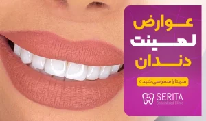 معایب و عوارض لمینت دندان