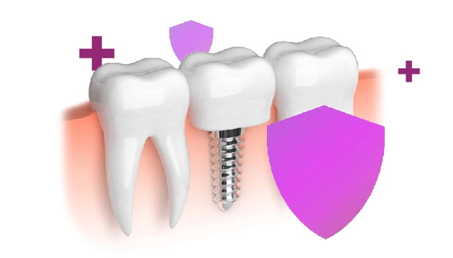 مزایای ایمپلنت دندان