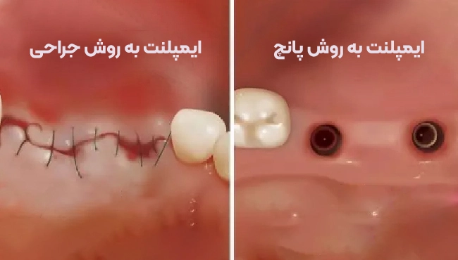 تفاوت کاشت ایمپلنت در روش جراحی با پانچ