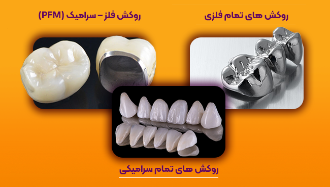 انواع روکش دندان، روکش های تمام فلزی، روکش فلز و سرامیک pfm، روکش های تمام سرامیکی