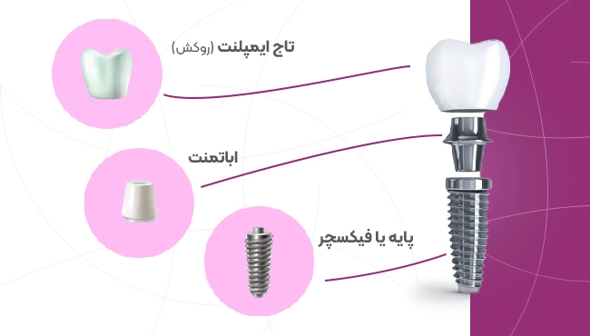 اجزای ایمپلنت