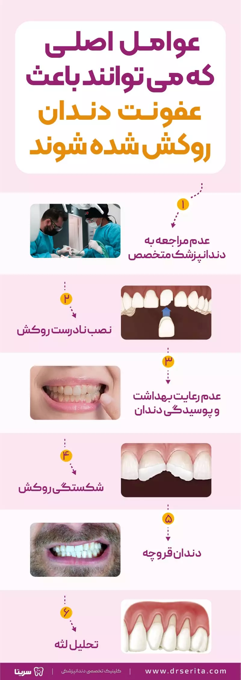 عفونت دندان روکش شده و عوامل آن، 6 دلیل عفونت دندان روکش شده