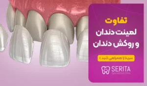 تفاوت لمینت دندان و روکش دندان