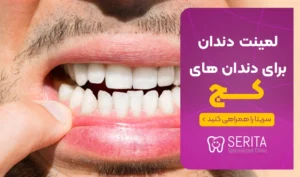 لمینت دندان برای دندان های کج