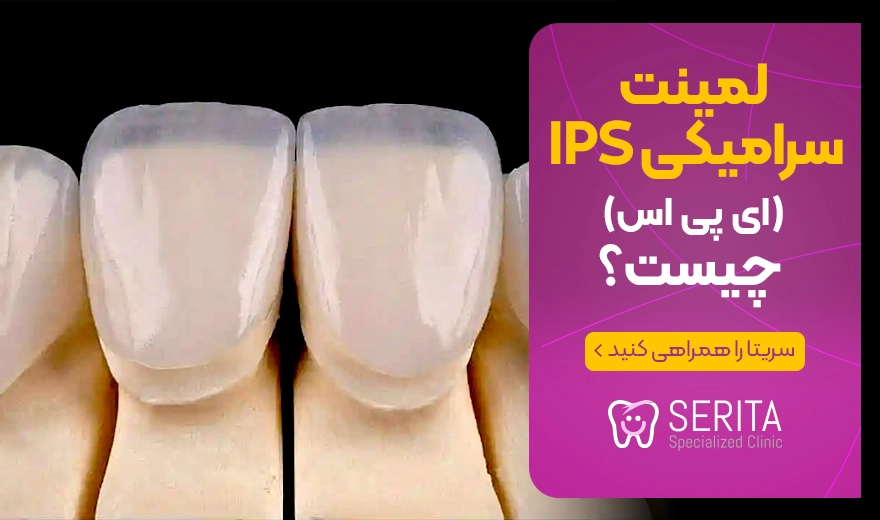 لمینت سرامیکی ips ای پی اس