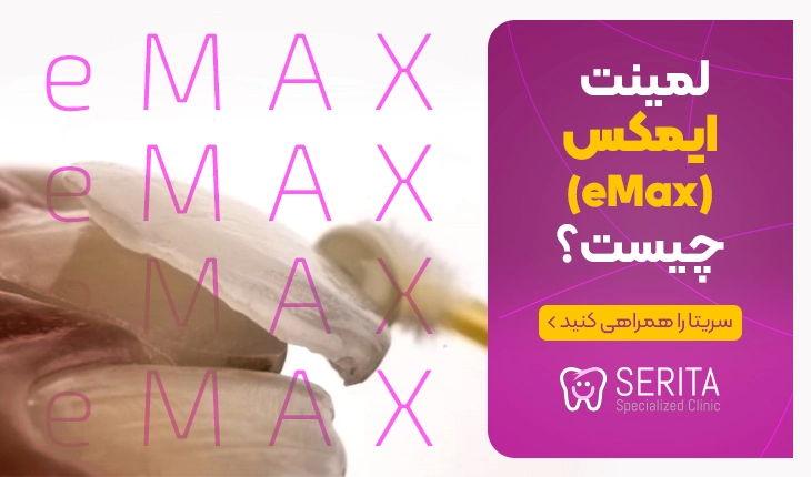 لمینت ایمکس emax چیست؟