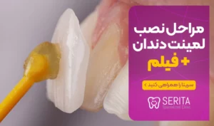 مراحل نصب لمینت دندان + فیلم