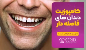 کامپوزیت دندان های فاصله دار