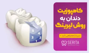 کامپوزیت دندان به روش لیرینگ