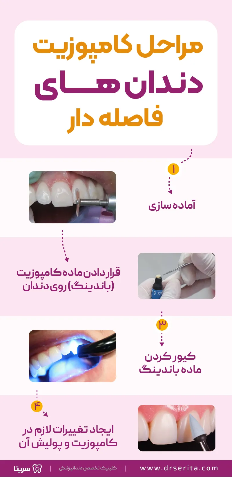 اینفوگرافیک مراحل کامپوزیت دندان فاصله دار