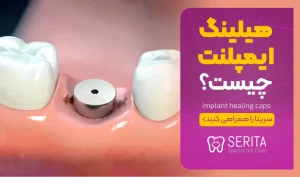 کلاهک هیلینگ ایمپلنت چیست؟ (implant healing caps)