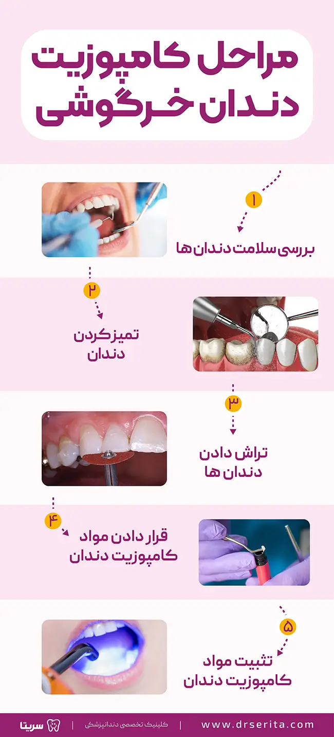 اینفوگرافیک مراحل کامپوزیت دندان خرگوشی