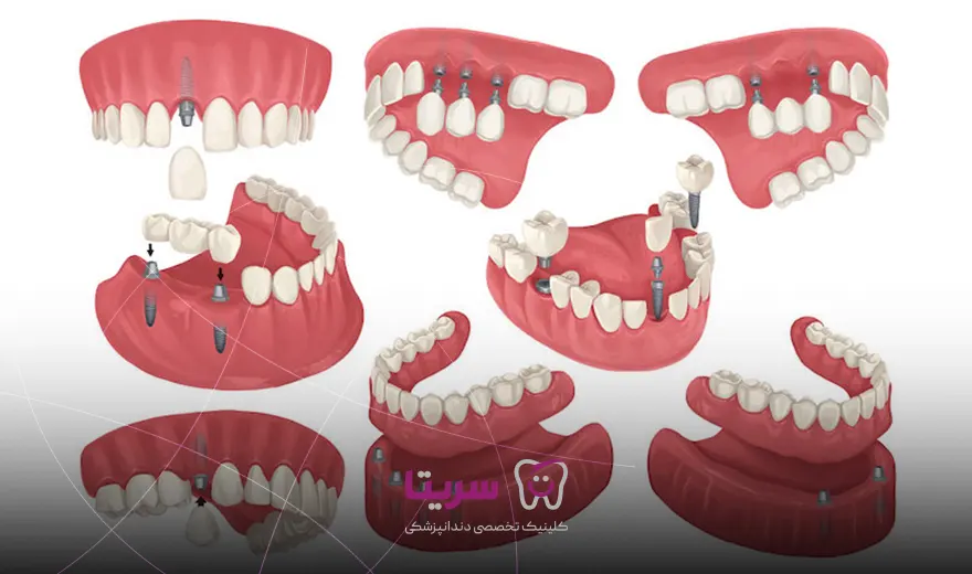 عکس انواع روش های ایمپلنت دندان