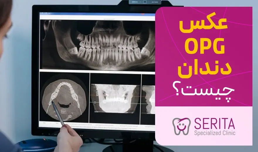 عکس OPG دندان چیست و چه کاربردی دارد؟