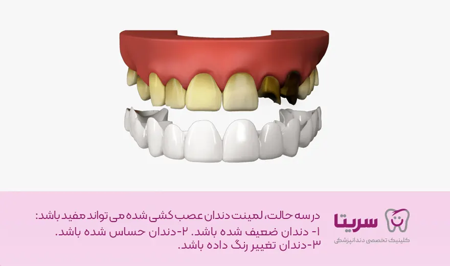 حالت های لمینت دندان عصب کشی شده