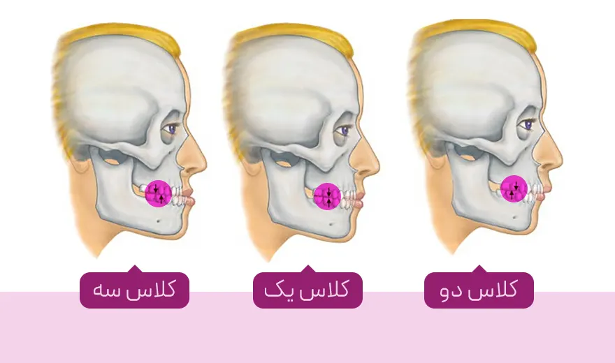 انواع انحراف فک، شکل سه کلاس انحراف فک