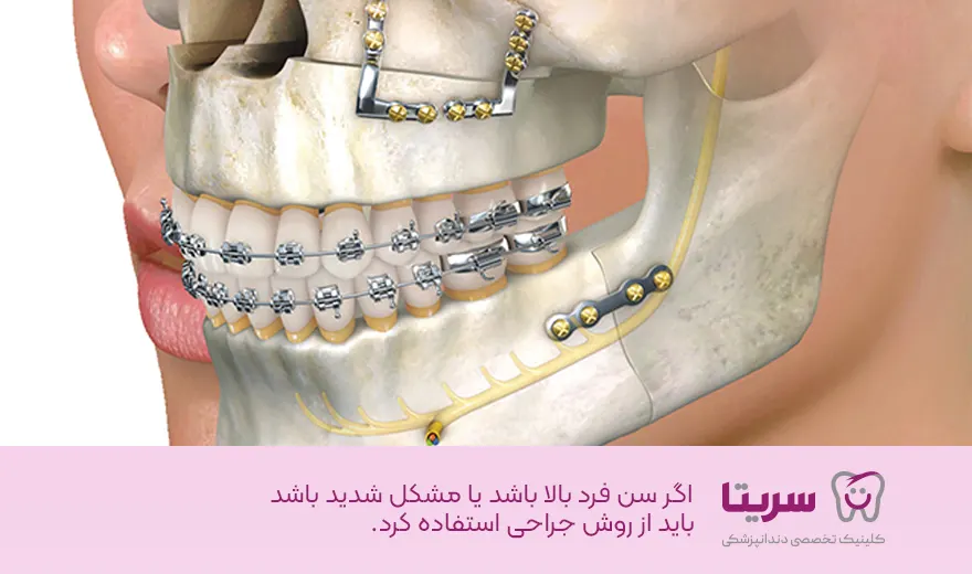 درمان انحراف فک روش جراحی و غیر جراحی