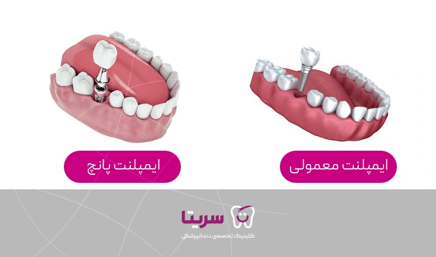تفاوت ایمپلنت پانچ و ایمپلنت معمولی
