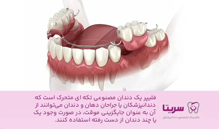 دندان مصنوعی فلیپر چیست + توضیح