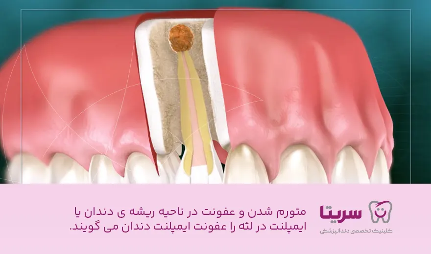 عفونت ایمپلنت دندان چیست؟