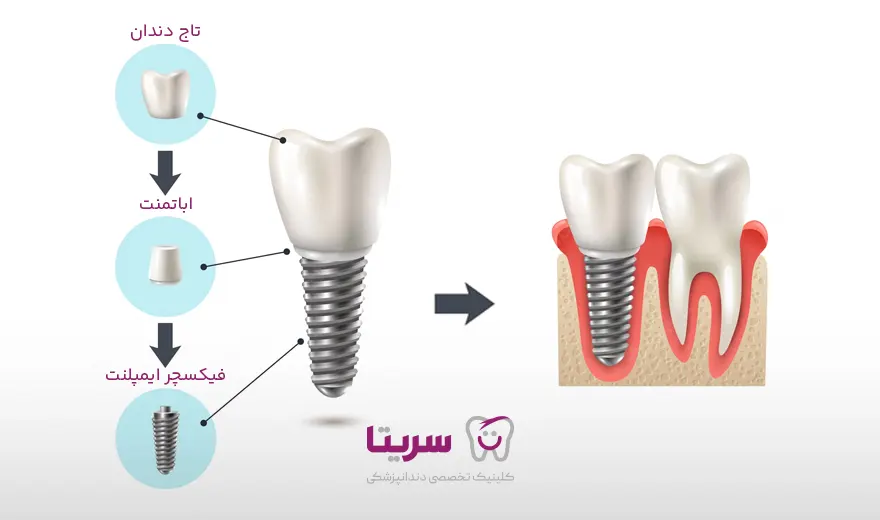 اجزای تشکیل دهنده ایمپلنت