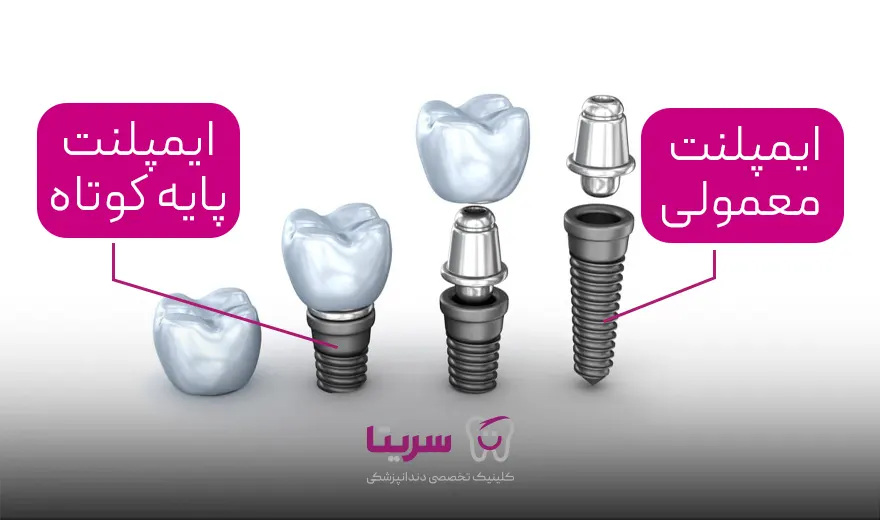 مقایسه و تفاوت ایمپلنت پایه کوتاه و معمولی