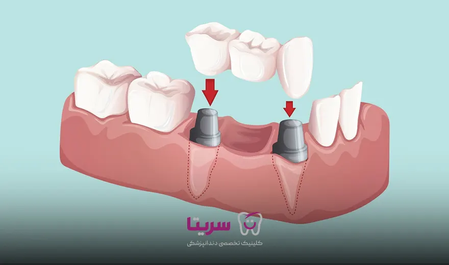 جراحی بریج بر پایه ایمپلنت