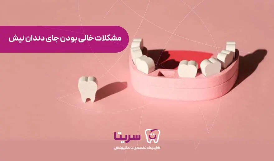 مشکلات خالی بودن جای دندان نیش