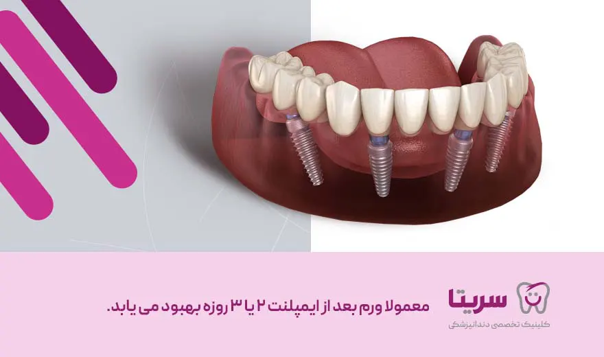 مدت زمان ورم بعد از ایمپلنت 