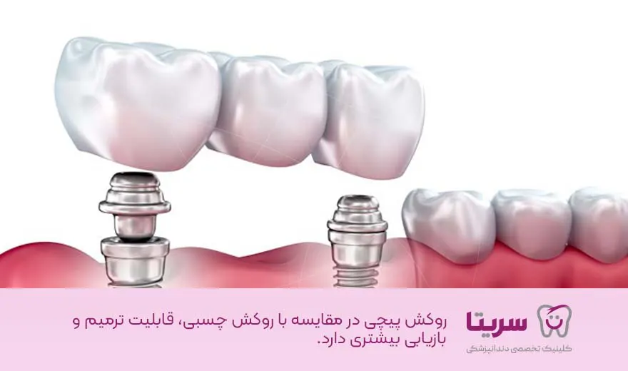 ایمپلنت پیچی، مزایای ایمپلنت پیچی