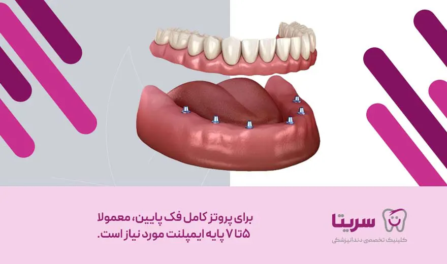 تعداد ایمپلنت لازم برای فک پایین