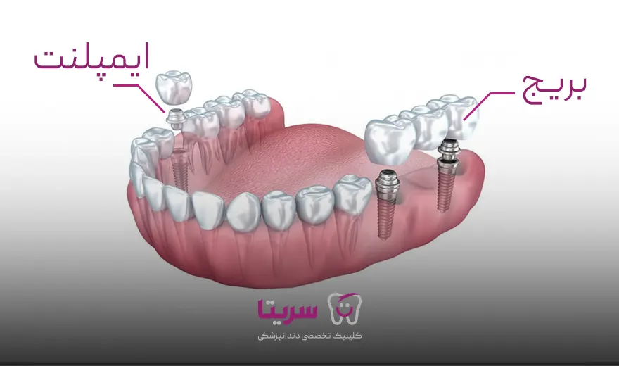 تفاوت بریج و ایمپلنت دندان 