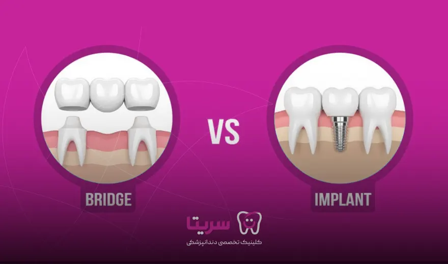 ایمپلنت بهتر است یا بریج؟ , مقایسه بری و ایمپلنت